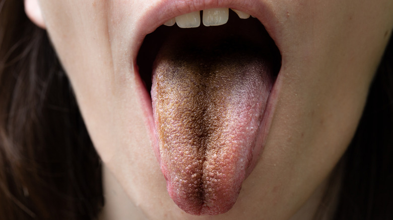 Black hairy tongue