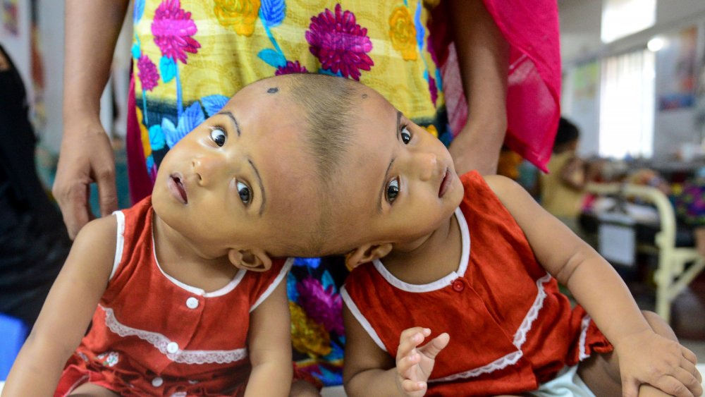 What Life Is Really Like As A Conjoined Twin what-life-is-really-like-as-a-conjoined-twin