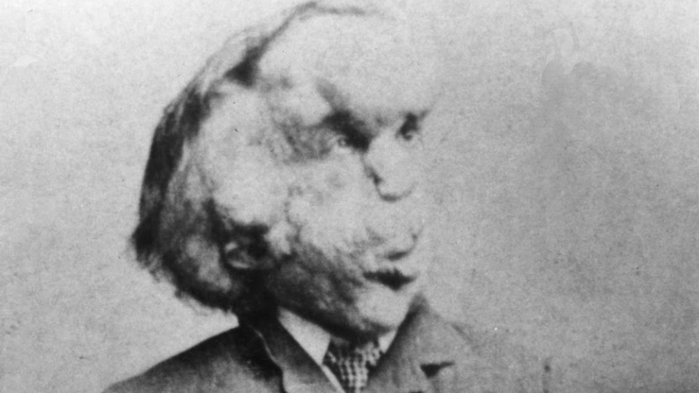 Joseph Merrick, the Elephant Man