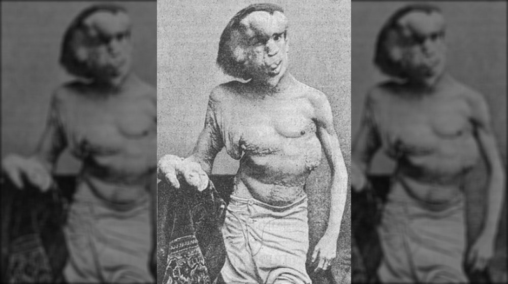 Joseph Merrick, the Elephant Man