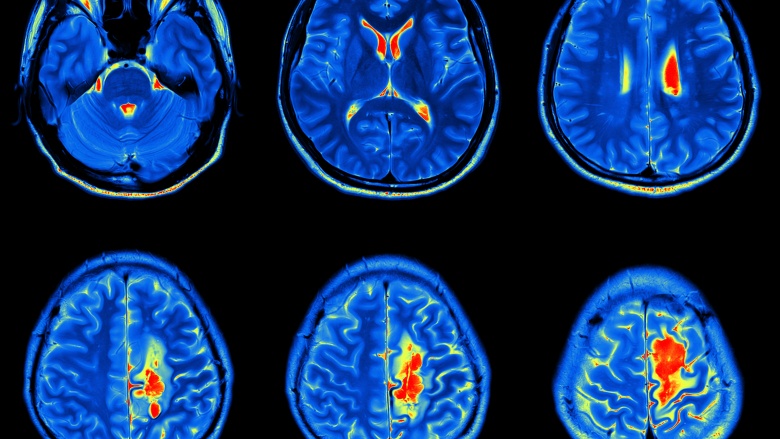 brain scans