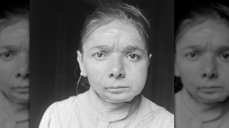 Phossy jaw patient