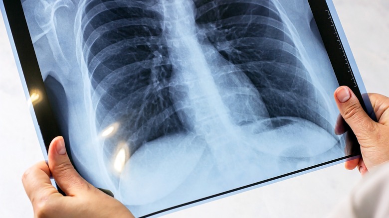 woman holding chest x-ray