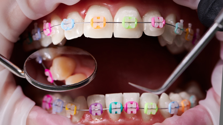Braces on teeth