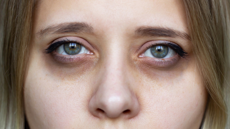Tired eyes